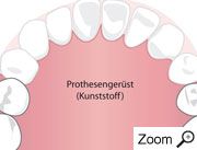 Drahtklammerprothese